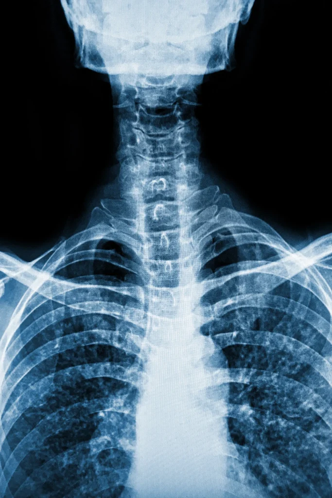 X-Ray Image Of Spine
